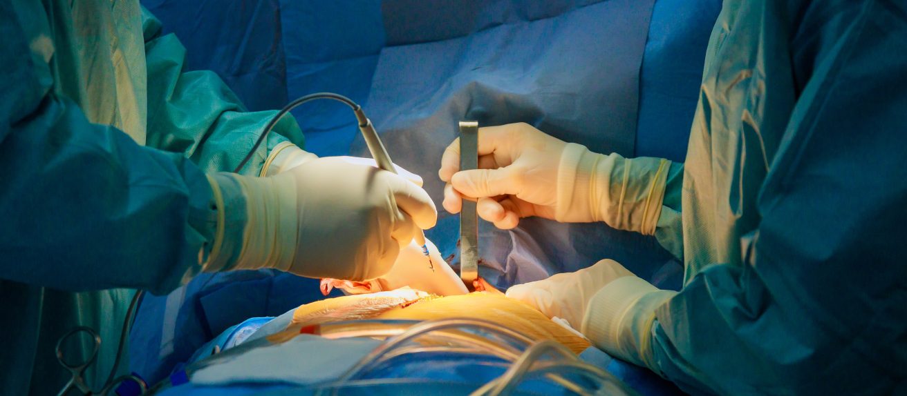 Intervention chirurgicale cardiaque illustrant une chirurgie de l’aorte
