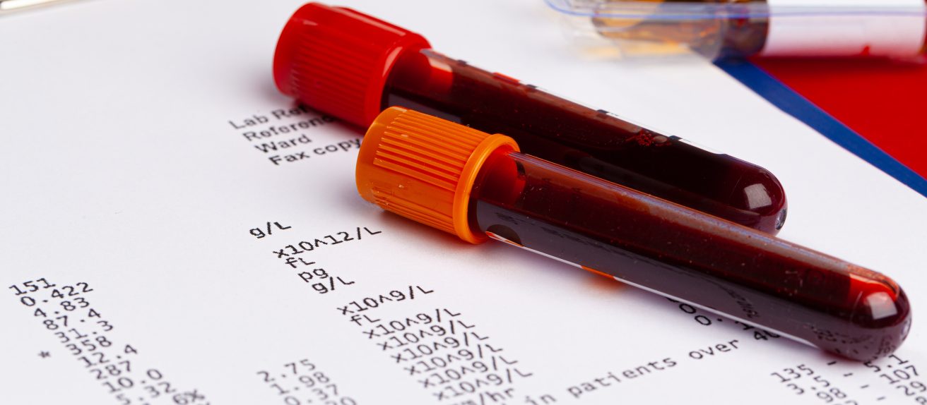 Résultat d’analyse sanguine illustrant le dosage de la troponine