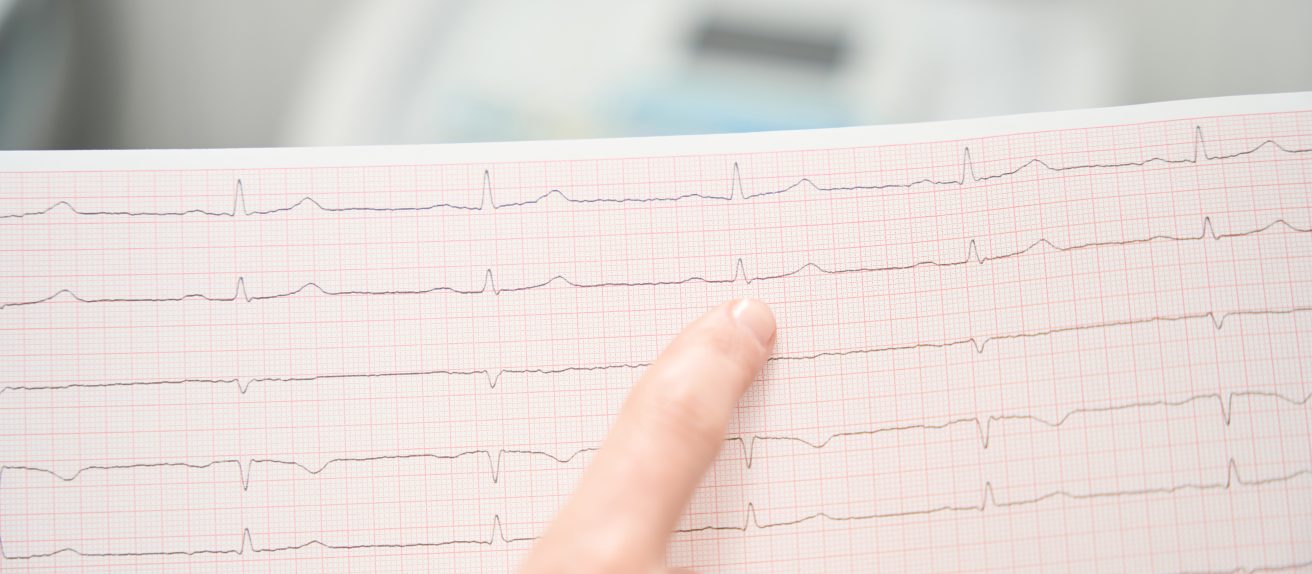 Tracé d’électrocardiogramme imprimé sur papier illustrant l’activité électrique du cœur