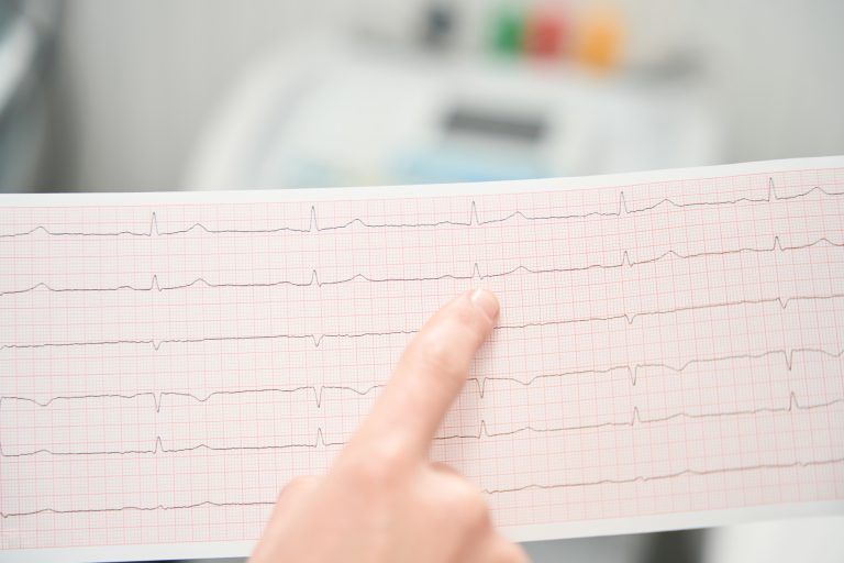 Tracé d’électrocardiogramme imprimé sur papier illustrant l’activité électrique du cœur