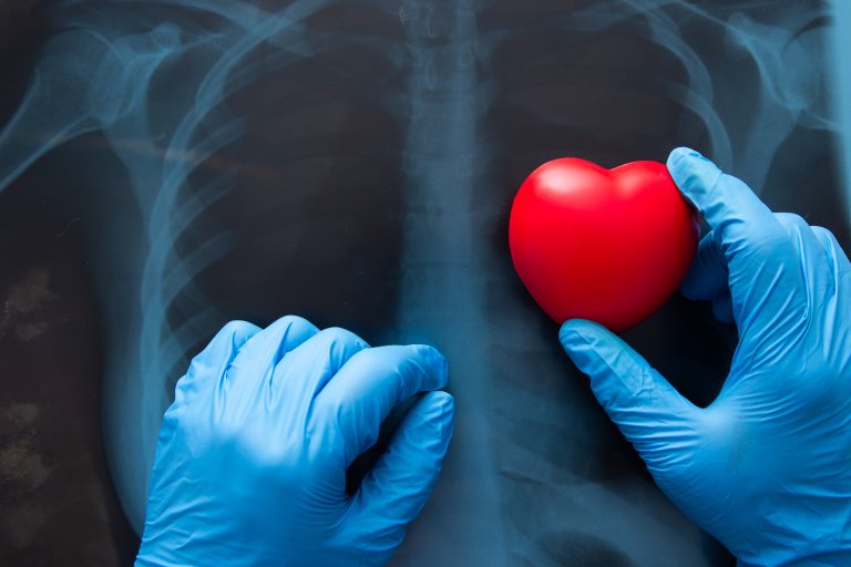 Radiographie du thorax avec un cœur symbolique superposé illustrant une transplantation cardiaque